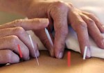 acupuntura-itaim-1382717964