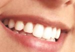 implantes-dentarios-itaim-1382724014